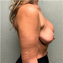 Breast Implant Revision Before Photo by Michael Yang, MD; Bettendorf, IA - Case 50680