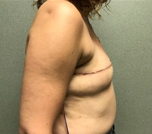 Breast Reconstruction Before Photo by Michael Yang, MD; Bettendorf, IA - Case 50681