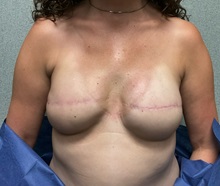 Breast Reconstruction After Photo by Michael Yang, MD; Bettendorf, IA - Case 50681