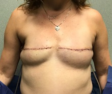 Breast Reconstruction Before Photo by Michael Yang, MD; Bettendorf, IA - Case 50681