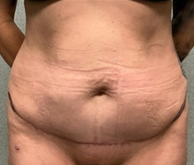 Tummy Tuck After Photo by Michael Yang, MD; Bettendorf, IA - Case 50684