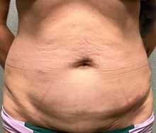 Tummy Tuck Before Photo by Michael Yang, MD; Bettendorf, IA - Case 50684