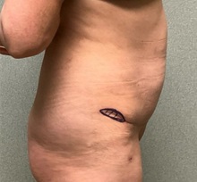 Tummy Tuck After Photo by Michael Yang, MD; Bettendorf, IA - Case 50684
