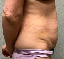 Tummy Tuck Before Photo by Michael Yang, MD; Bettendorf, IA - Case 50684