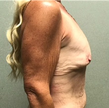 Breast Augmentation Before Photo by Michael Yang, MD; Bettendorf, IA - Case 50688