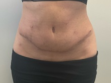 Tummy Tuck After Photo by Michael Yang, MD; Bettendorf, IA - Case 50685
