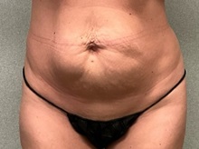 Tummy Tuck Before Photo by Michael Yang, MD; Bettendorf, IA - Case 50685