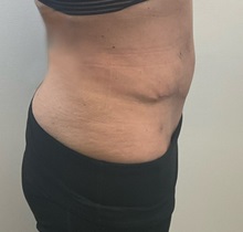 Tummy Tuck After Photo by Michael Yang, MD; Bettendorf, IA - Case 50685