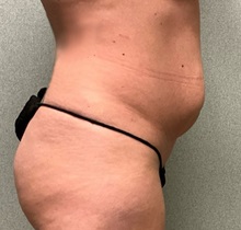 Tummy Tuck Before Photo by Michael Yang, MD; Bettendorf, IA - Case 50685