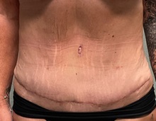 Tummy Tuck After Photo by Michael Yang, MD; Bettendorf, IA - Case 50687
