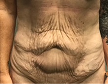 Tummy Tuck Before Photo by Michael Yang, MD; Bettendorf, IA - Case 50687