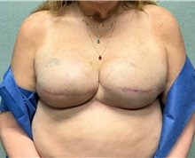 Breast Reconstruction After Photo by Michael Yang, MD; Bettendorf, IA - Case 50691