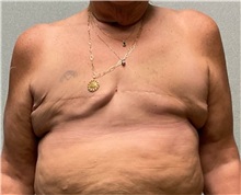 Breast Reconstruction Before Photo by Michael Yang, MD; Bettendorf, IA - Case 50691