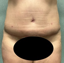 Tummy Tuck After Photo by Michael Yang, MD; Bettendorf, IA - Case 50692
