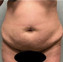 Tummy Tuck Before Photo by Michael Yang, MD; Bettendorf, IA - Case 50692