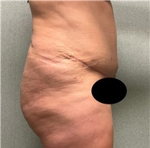Tummy Tuck After Photo by Michael Yang, MD; Bettendorf, IA - Case 50692