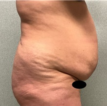 Tummy Tuck Before Photo by Michael Yang, MD; Bettendorf, IA - Case 50692