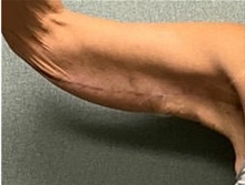 Arm Lift After Photo by Michael Yang, MD; Bettendorf, IA - Case 50738