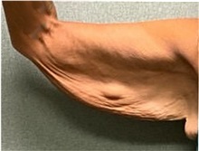 Arm Lift Before Photo by Michael Yang, MD; Bettendorf, IA - Case 50738