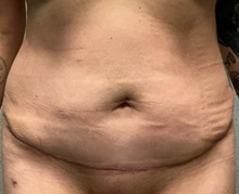 Panniculectomy After Photo by Michael Yang, MD; Bettendorf, IA - Case 50742