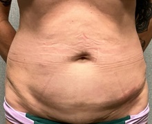Panniculectomy Before Photo by Michael Yang, MD; Bettendorf, IA - Case 50742