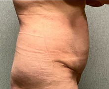 Panniculectomy After Photo by Michael Yang, MD; Bettendorf, IA - Case 50742