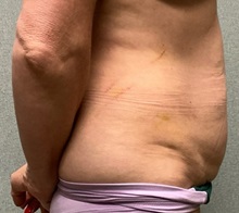 Panniculectomy Before Photo by Michael Yang, MD; Bettendorf, IA - Case 50742