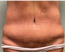Tummy Tuck After Photo by Michael Yang, MD; Bettendorf, IA - Case 50765