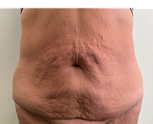 Tummy Tuck Before Photo by Michael Yang, MD; Bettendorf, IA - Case 50765
