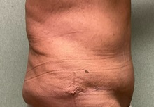 Tummy Tuck After Photo by Michael Yang, MD; Bettendorf, IA - Case 50765