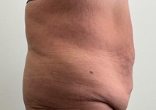 Tummy Tuck Before Photo by Michael Yang, MD; Bettendorf, IA - Case 50765