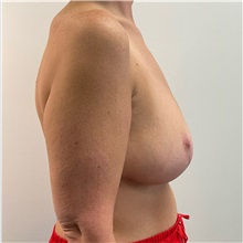Breast Lift After Photo by Michael Yang, MD; Bettendorf, IA - Case 50781