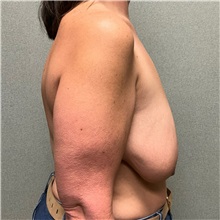 Breast Lift Before Photo by Michael Yang, MD; Bettendorf, IA - Case 50781