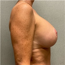 Breast Augmentation After Photo by Michael Yang, MD; Bettendorf, IA - Case 50813