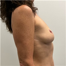 Breast Augmentation Before Photo by Michael Yang, MD; Bettendorf, IA - Case 50813