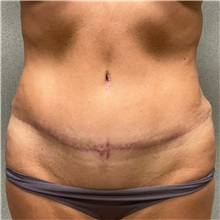 Tummy Tuck After Photo by Michael Yang, MD; Bettendorf, IA - Case 50814