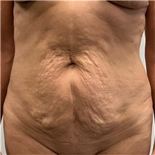 Tummy Tuck Before Photo by Michael Yang, MD; Bettendorf, IA - Case 50814