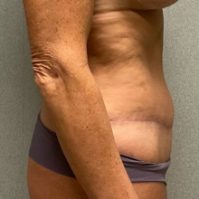 Tummy Tuck After Photo by Michael Yang, MD; Bettendorf, IA - Case 50814