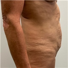 Tummy Tuck Before Photo by Michael Yang, MD; Bettendorf, IA - Case 50814