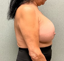 Breast Implant Revision After Photo by Michael Yang, MD; Bettendorf, IA - Case 50817