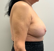 Breast Implant Revision Before Photo by Michael Yang, MD; Bettendorf, IA - Case 50817