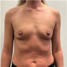 Breast Augmentation Before Photo by Michael Yang, MD; Bettendorf, IA - Case 50872