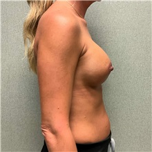 Breast Augmentation After Photo by Michael Yang, MD; Bettendorf, IA - Case 50872