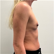 Breast Augmentation Before Photo by Michael Yang, MD; Bettendorf, IA - Case 50872