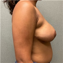 Breast Reduction After Photo by Michael Yang, MD; Bettendorf, IA - Case 50873