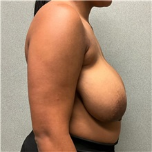 Breast Reduction Before Photo by Michael Yang, MD; Bettendorf, IA - Case 50873