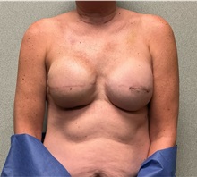 Breast Reconstruction After Photo by Michael Yang, MD; Bettendorf, IA - Case 50875