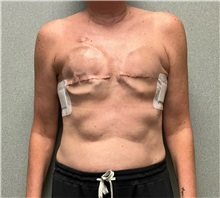 Breast Reconstruction Before Photo by Michael Yang, MD; Bettendorf, IA - Case 50875