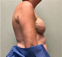 Breast Reconstruction After Photo by Michael Yang, MD; Bettendorf, IA - Case 50875