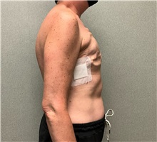 Breast Reconstruction Before Photo by Michael Yang, MD; Bettendorf, IA - Case 50875